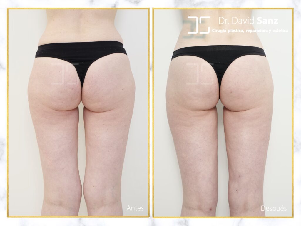 Liposucción de Piernas: Coste y Guía Completa