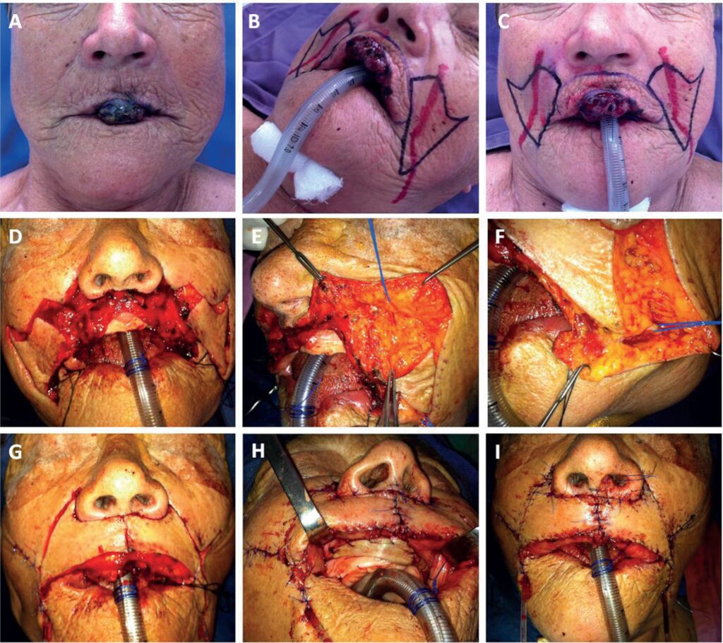 Guía Postoperatoria para Cirugía de Colgajo