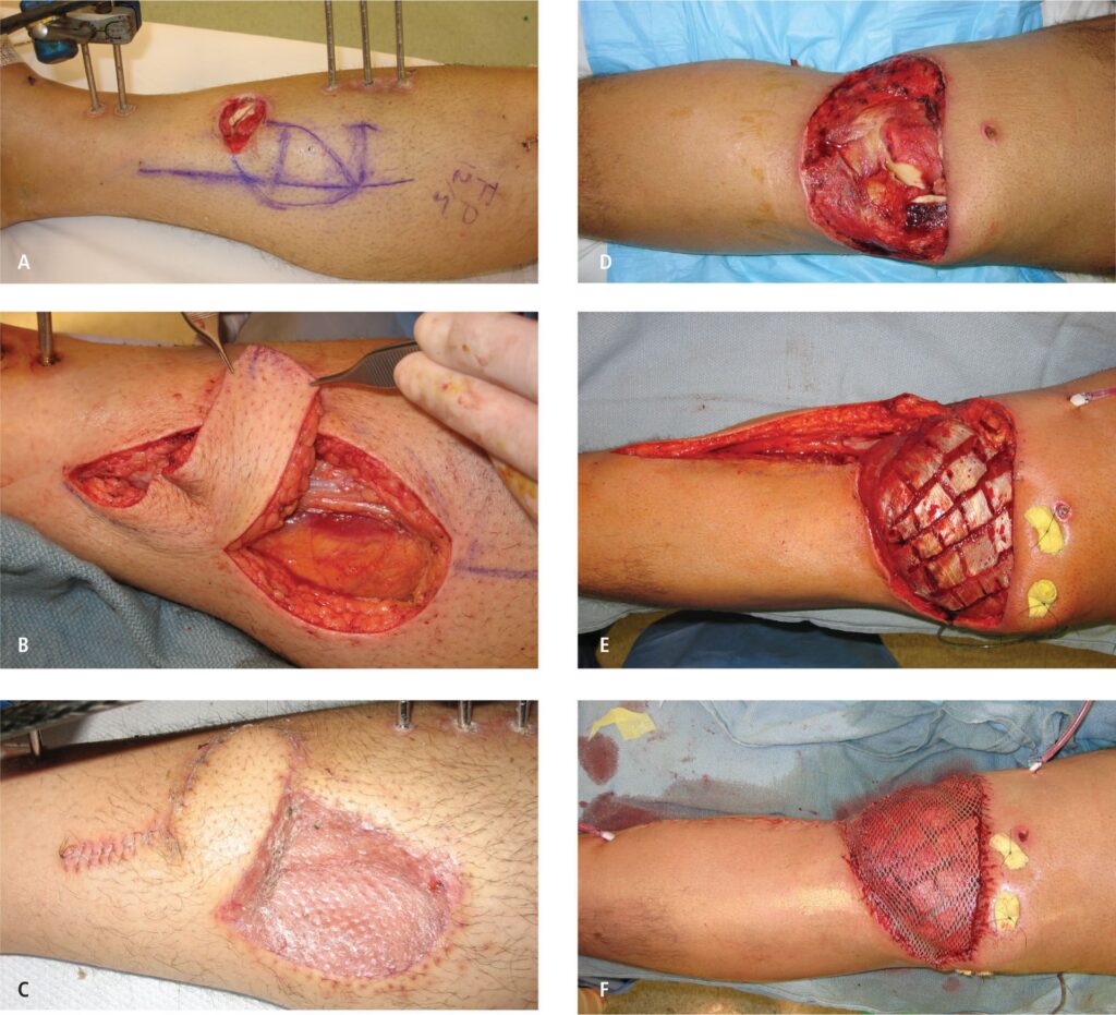 Injerto vs. Colgajo: ¿Cuál es la Diferencia?