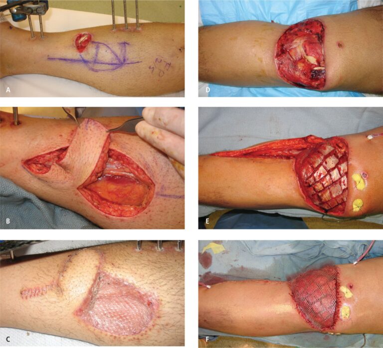 Injertos de Piel: Guía Completa de Cirugía Plástica