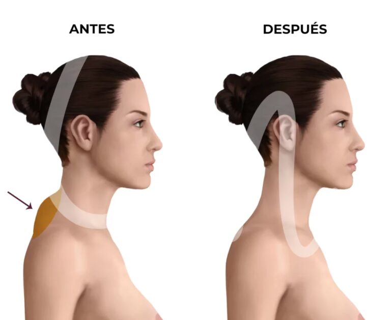 Cirugía para Quitar la Joroba: Guía Completa