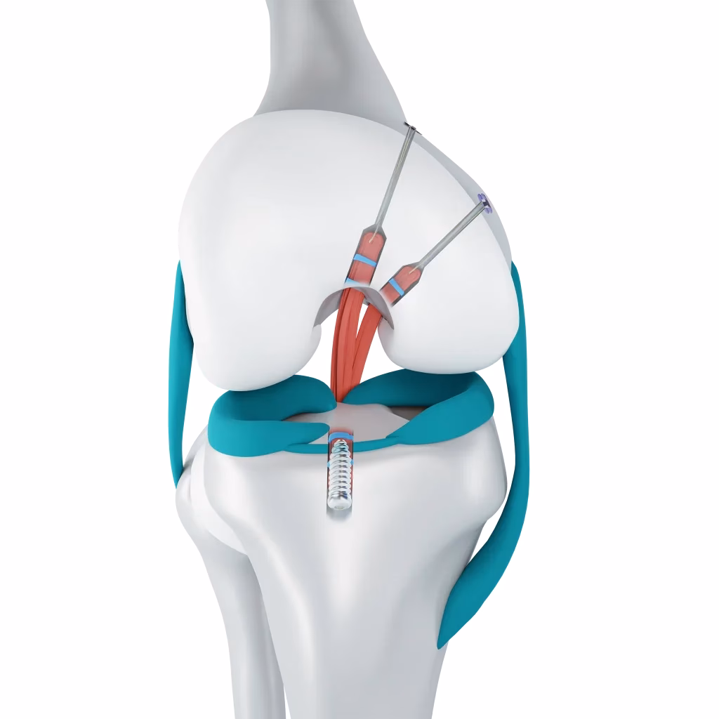 ¿Cuánto tiempo dura la recuperación de una cirugía de ligamento cruzado anterior?