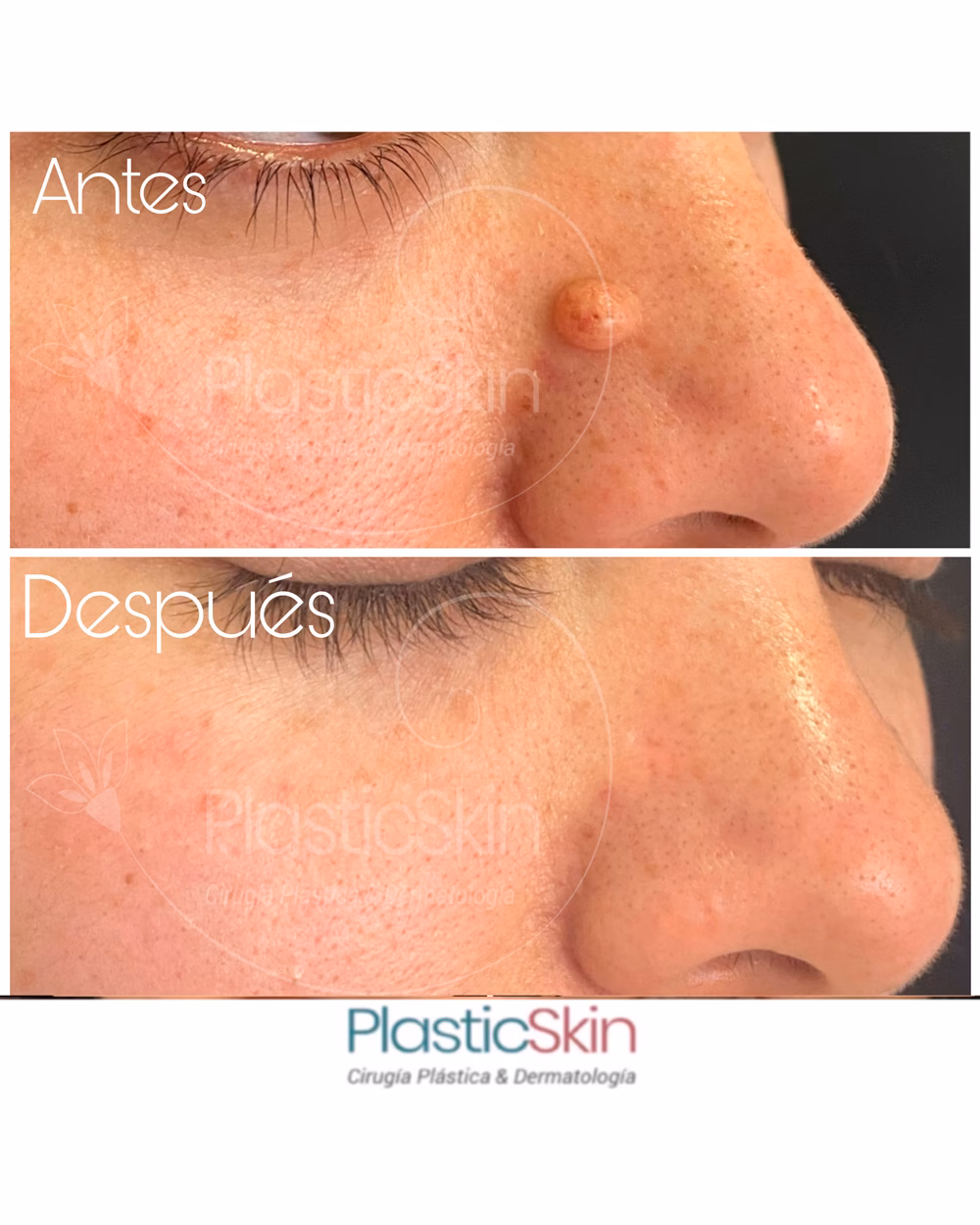 ¿Cómo se quitan los lunares de la nariz?