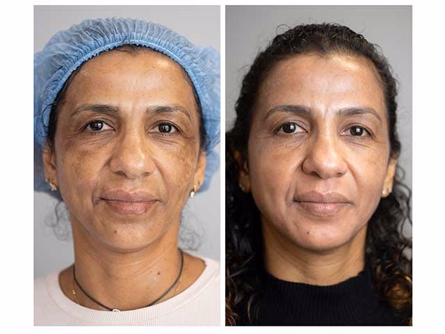 ¿Cuánto cobran por quitar manchas con láser?