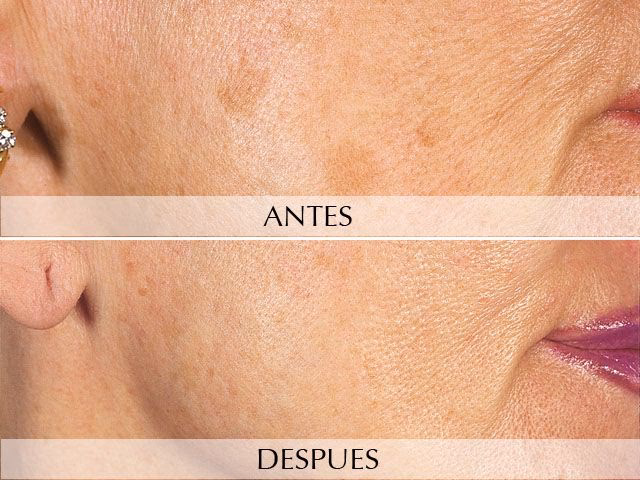 ¿Cuántos años dura una cirugía plástica en la cara?