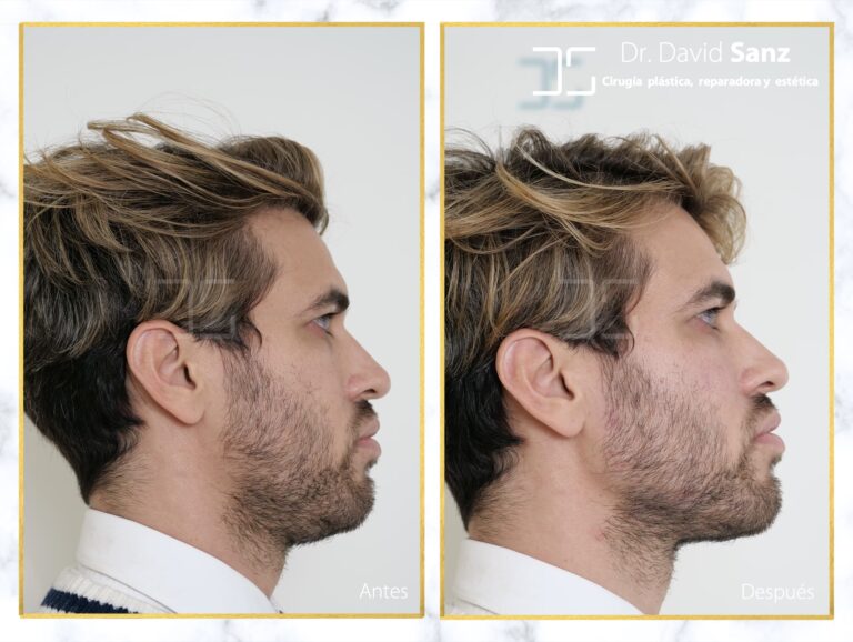 Cirugía de Mandíbula: Costos y Recuperación