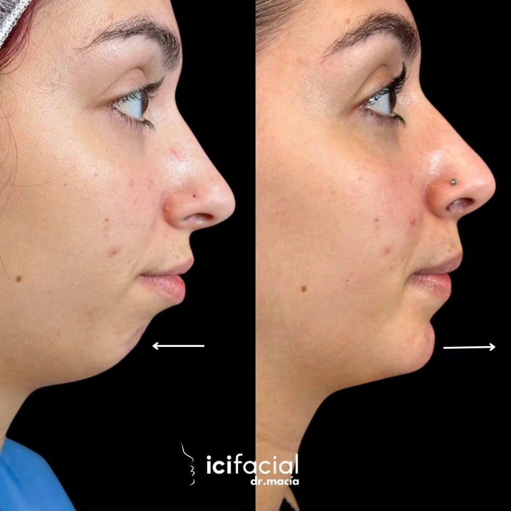 Implante de Mentón: ¿Una Solución Permanente?