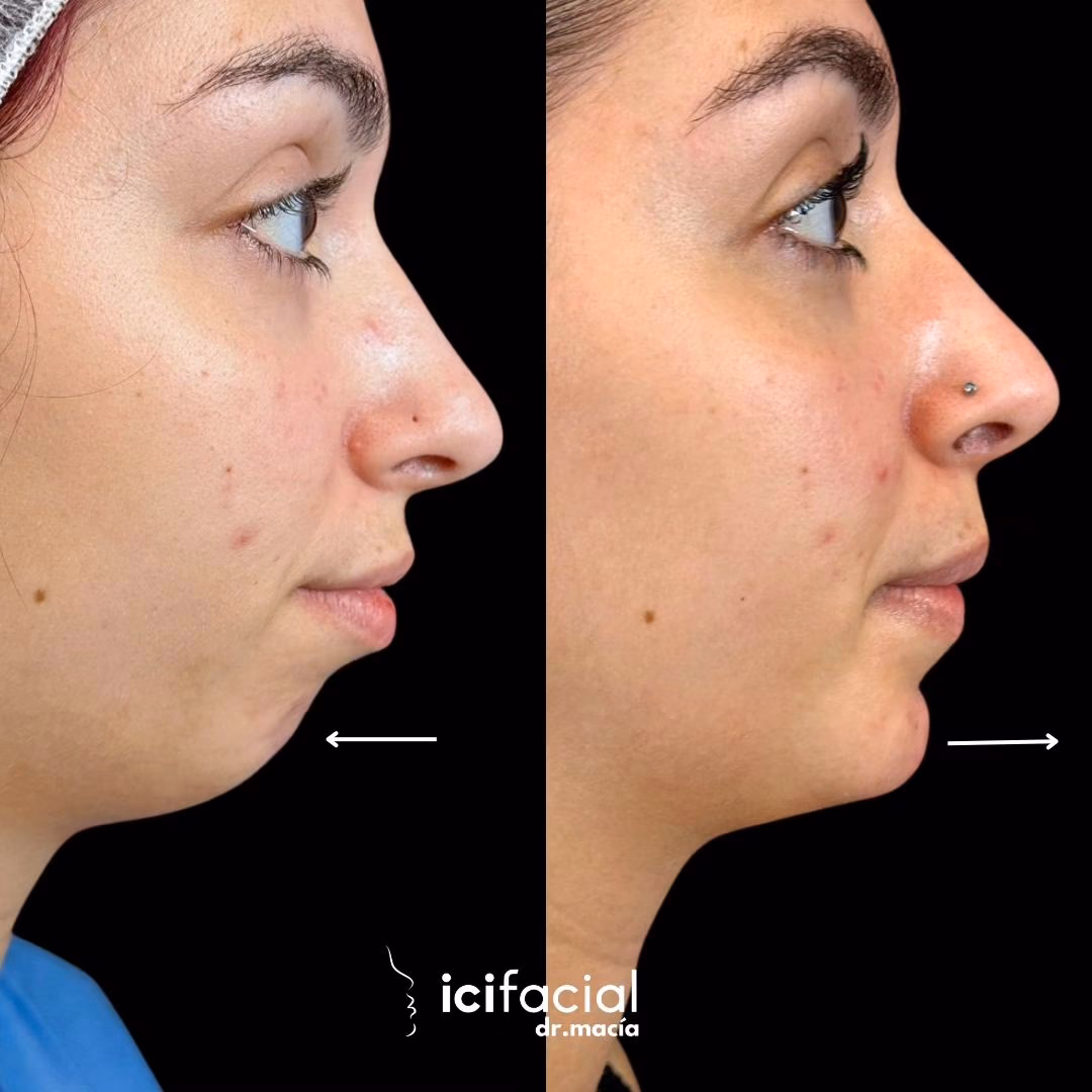 ¿Qué tan riesgosa es una mentoplastia?