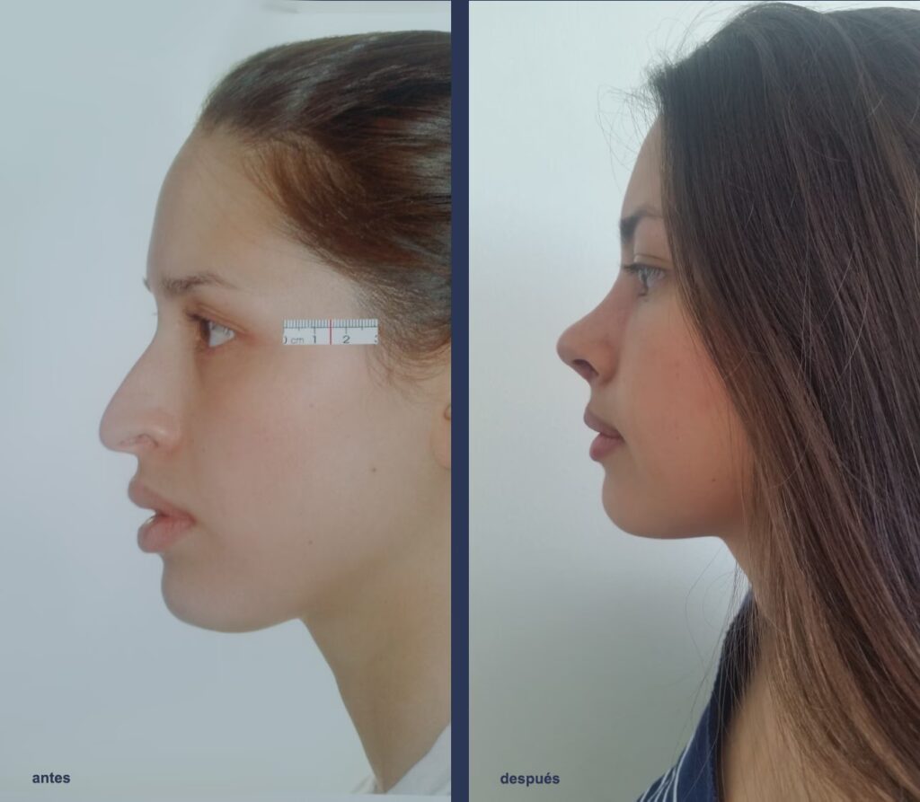 Rinoplastia en Bogotá: Guía de Precios y Claves