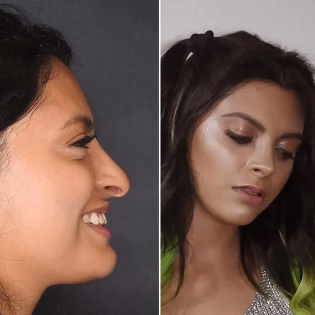 ¿Cuál es el mejor cirujano de rinoplastia en Colombia?