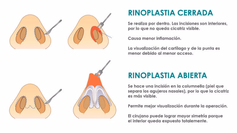 ¿Cuánto cuesta una rinoplastia cerrada?