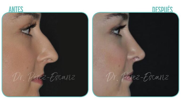 Precio de la Rinoplastia Cerrada: Guía Completa