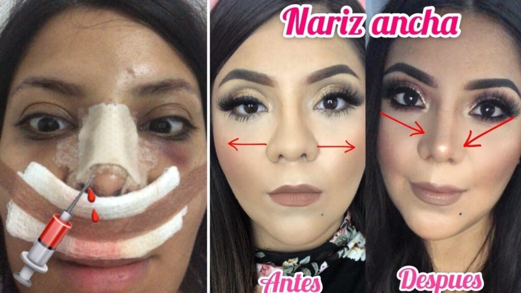 Cirugía de Nariz Chata: Guía Completa