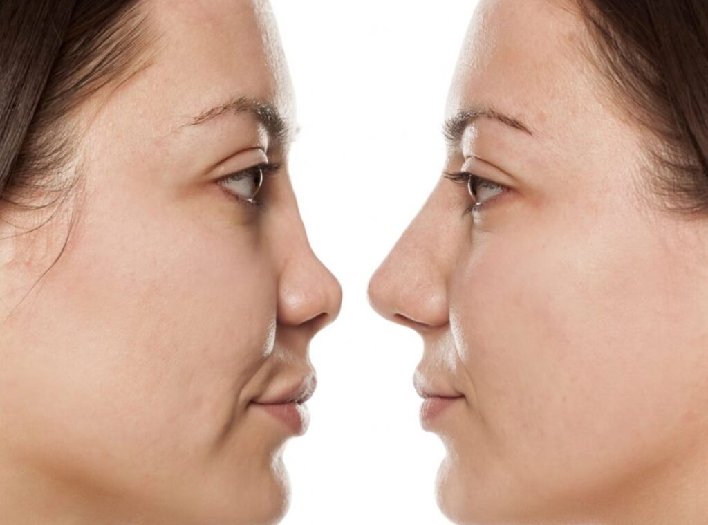 Guía Definitiva para Financiar tu Rinoplastia