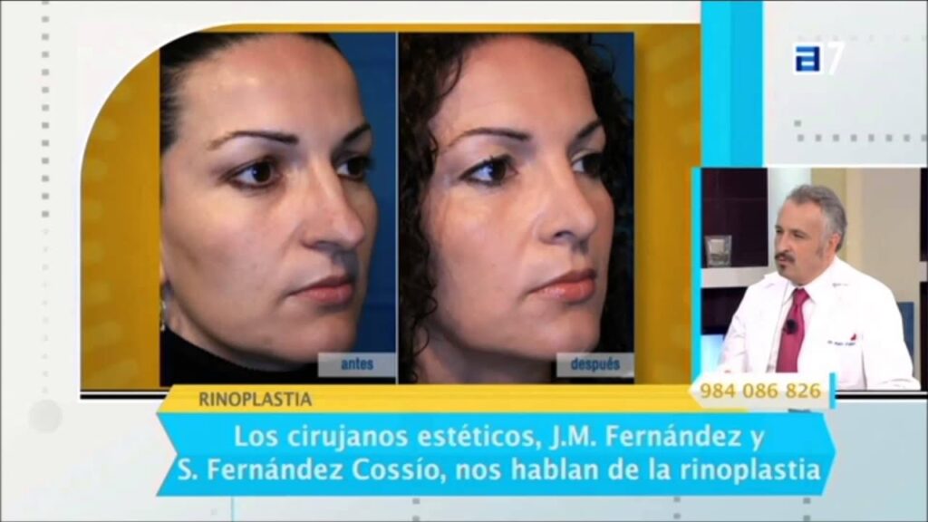 Rinoplastia Gratuita: ¿Mito o Realidad Absoluta?
