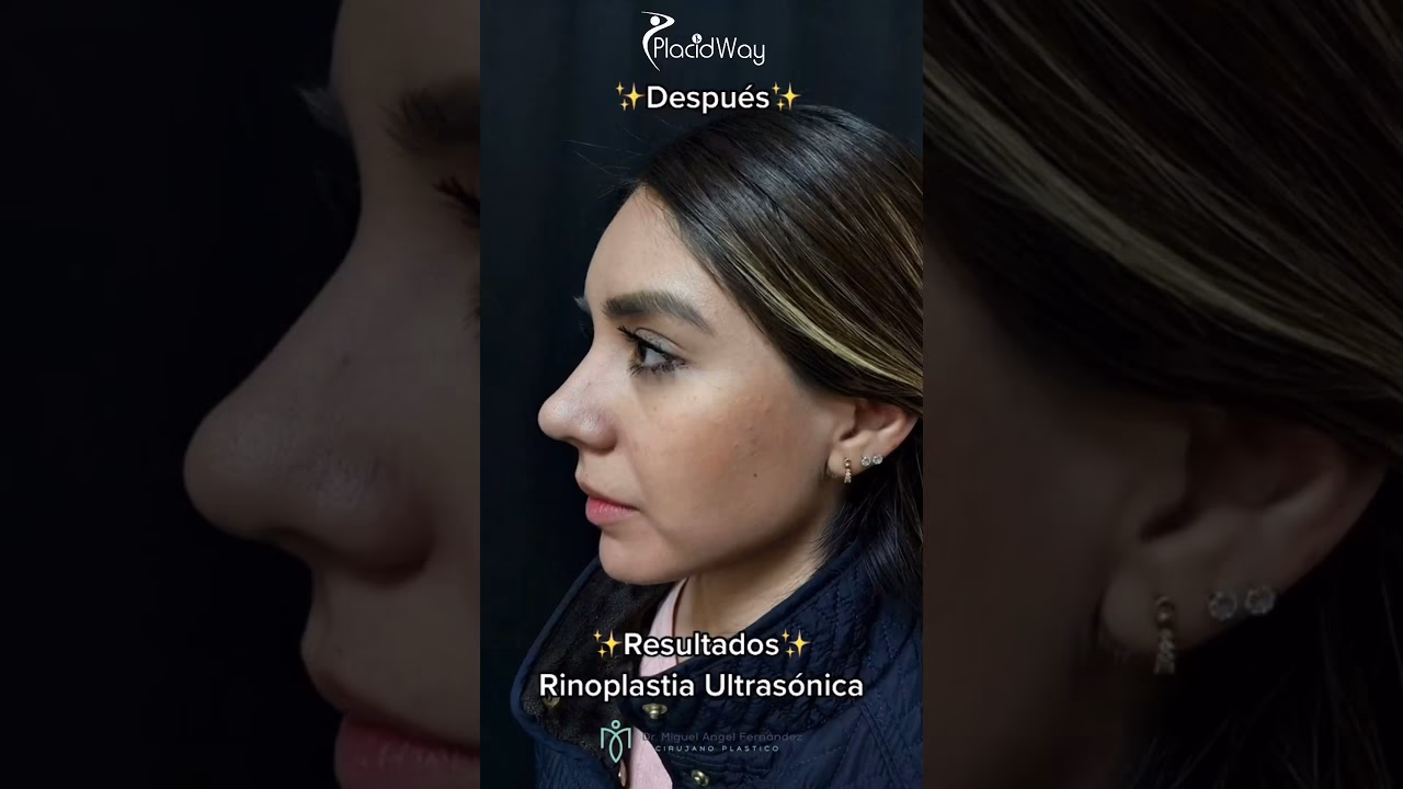 ¿Cómo hacer que el seguro me cubre una rinoplastia?