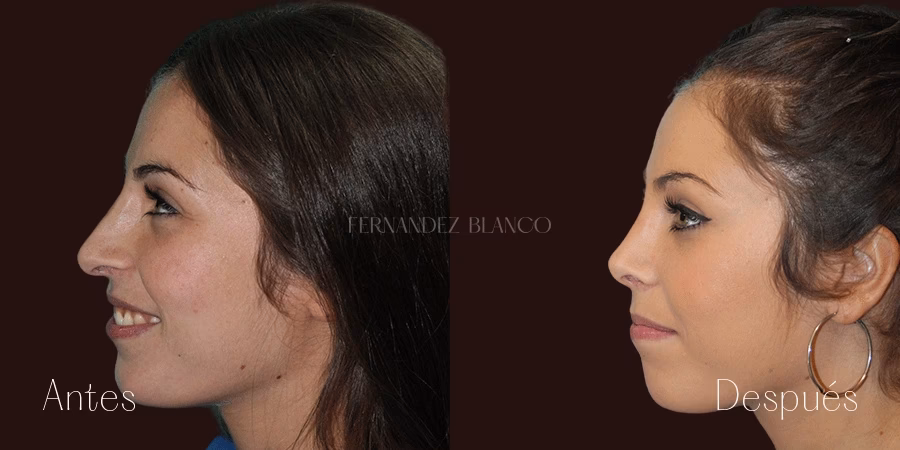 ¿Cómo conseguir una rinoplastia gratuita?