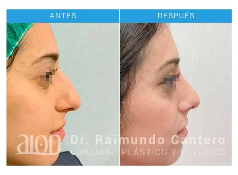 Guía de la Inflamación Post-Rinoplastia