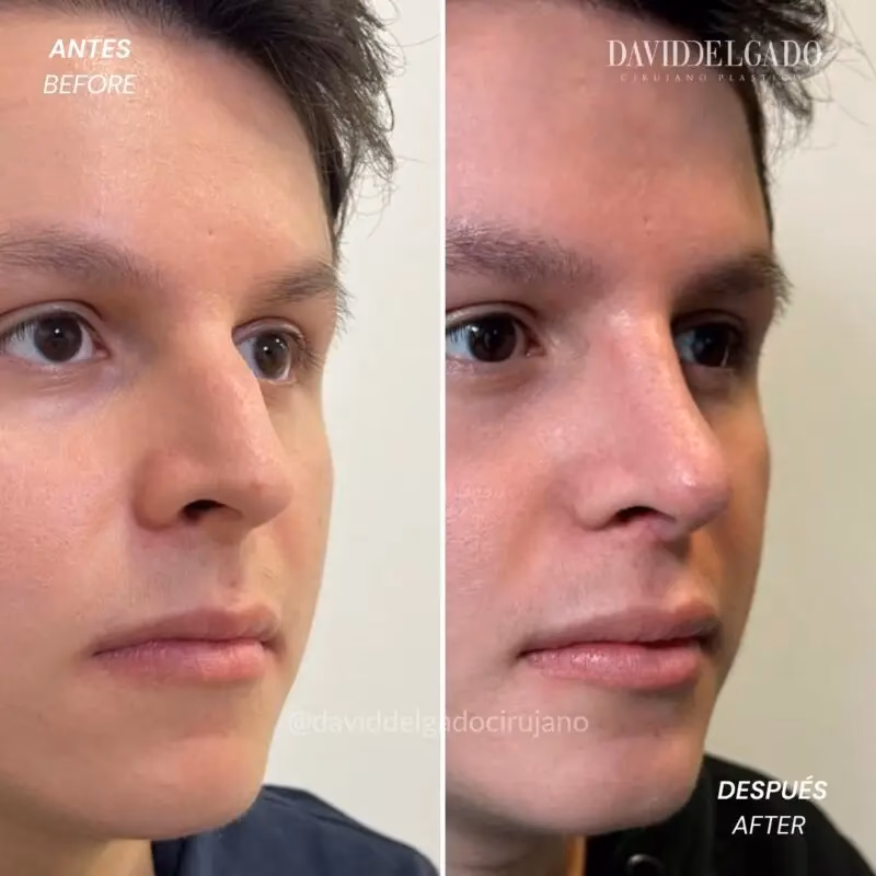 Guía de la Inflamación Post-Rinoplastia