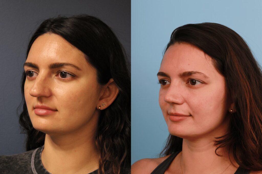 Fumadores y Rinoplastia: ¿Es Posible la Cirugía?