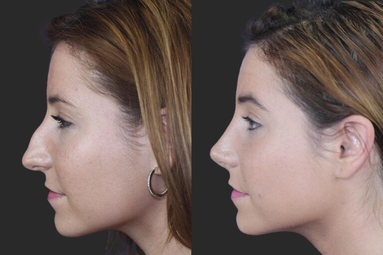 Rinoplastia: ¿Resultados para siempre? Precios y Claves