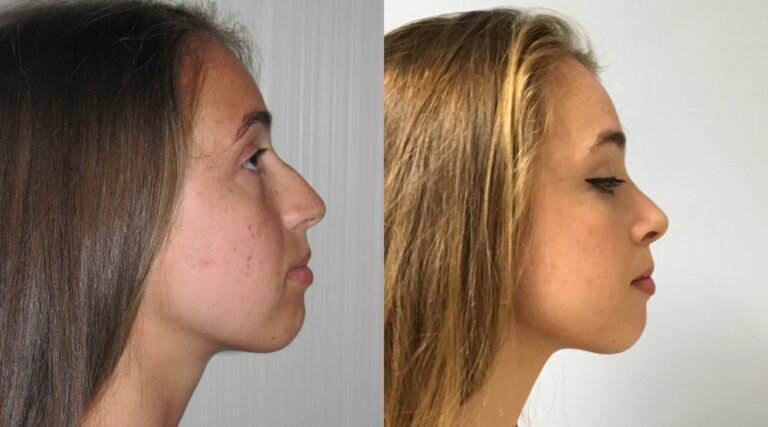 Rinoplastia en Argentina: La Guía Definitiva