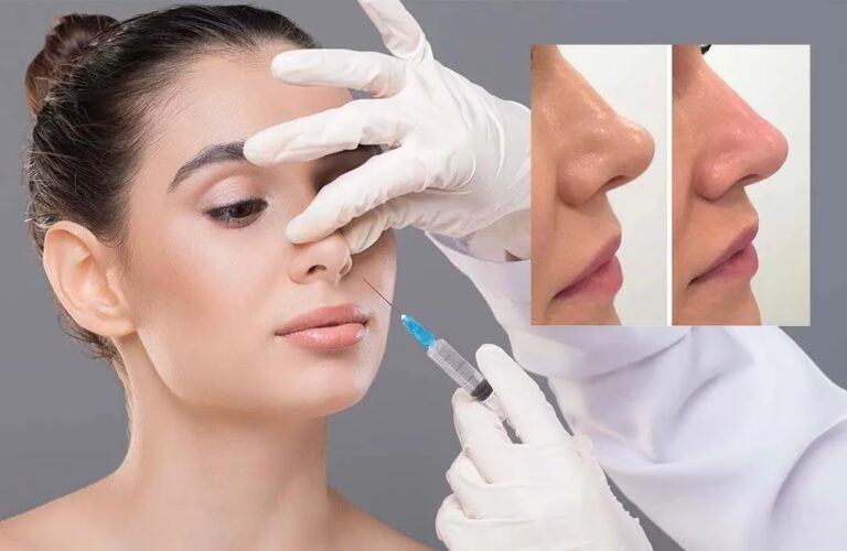 Rinomodelación: La Nariz Perfecta Sin Cirugía