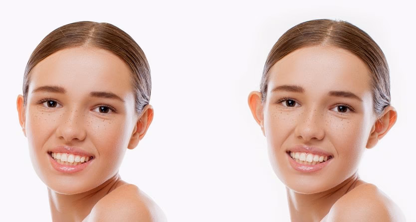 ¿Cuáles son los riesgos de la otoplastia?