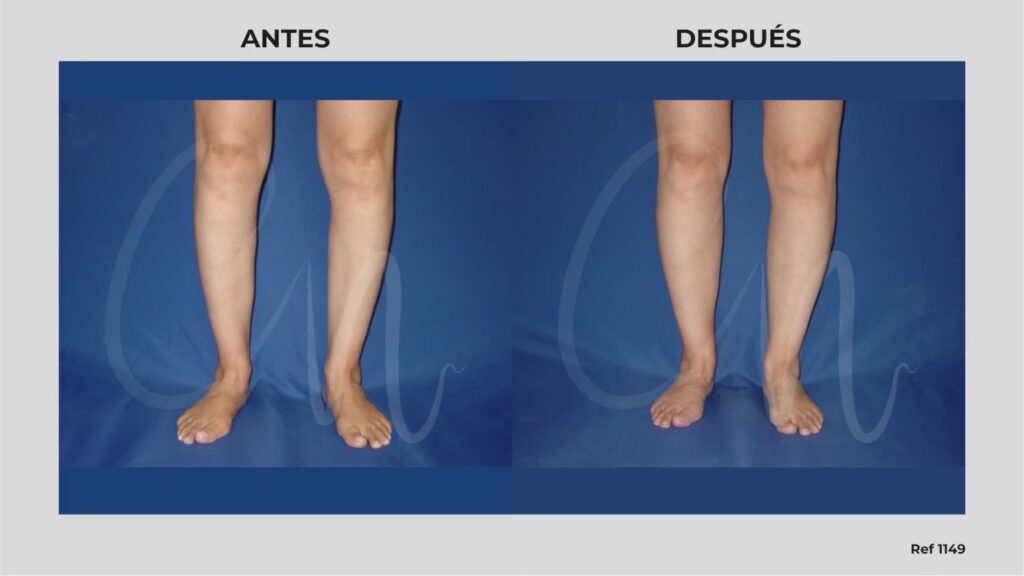 Liposucción de Pantorrillas: ¿Vale la Pena?