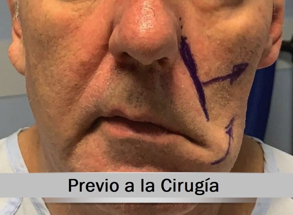 Cirugía de Parálisis Facial: Recupera tu Sonrisa