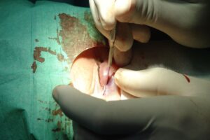 Blefaroplastia: Técnica Quirúrgica Paso a Paso