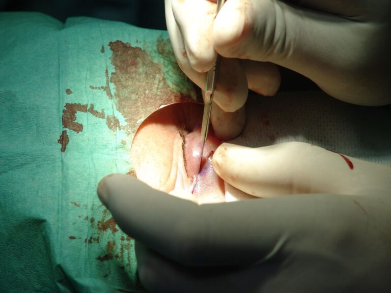 Blefaroplastia: Técnica Quirúrgica Paso a Paso