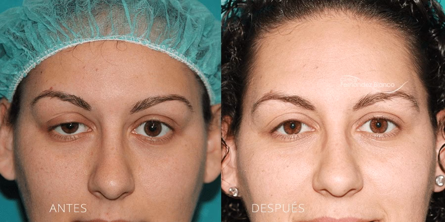 ¿Cómo quedan los ojos después de una cirugía de párpados?