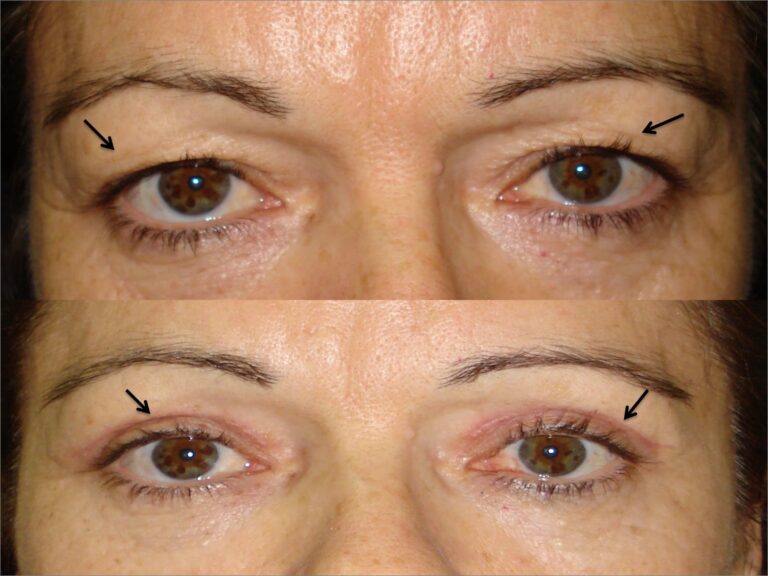Cirugía de Párpados: Guía de Precios y Resultados