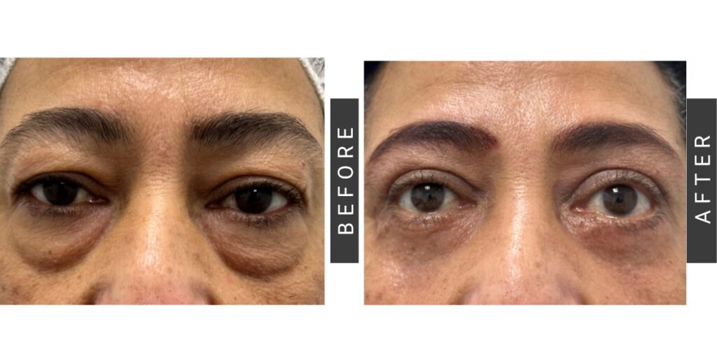 Blefaroplastia Inferior: ¿Cuánto duran los efectos?