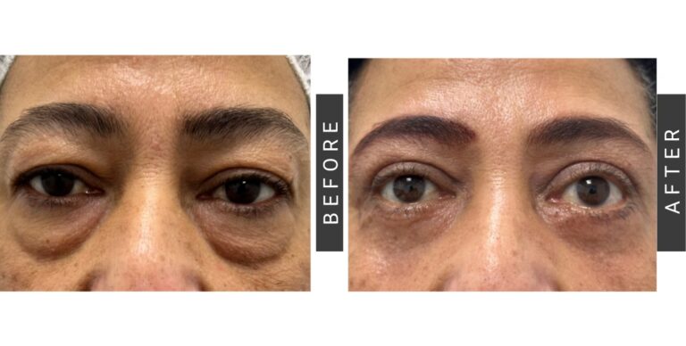 Blefaroplastia Inferior: ¿Cuánto duran los efectos?