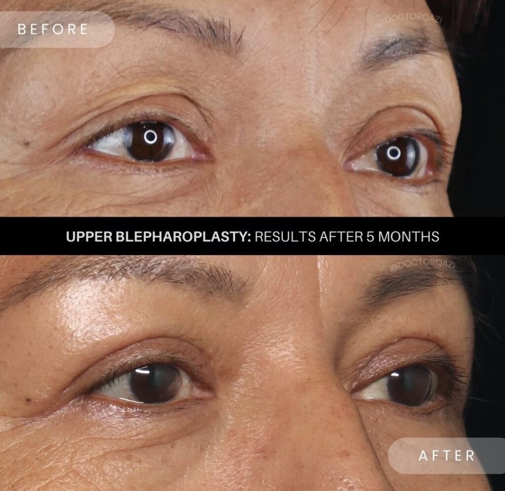 Blefaroplastia: La Edad Ideal para tu Mirada