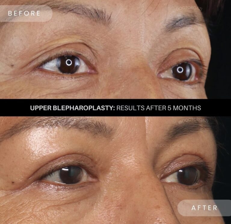 Precio Blefaroplastia Completa: Guía de Costes