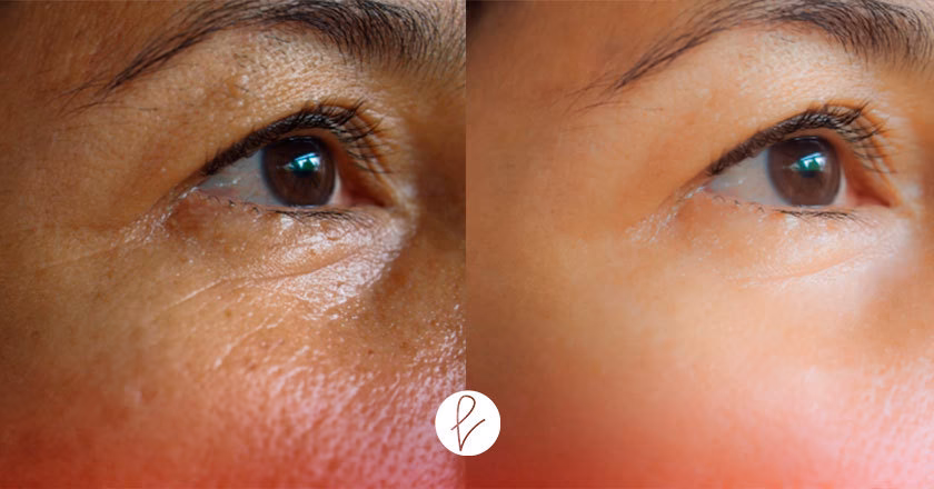 ¿Qué cirugía elimina las patas de gallo?