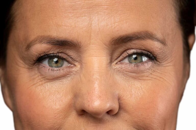 Elimina las Patas de Gallo: Guía de Tratamientos