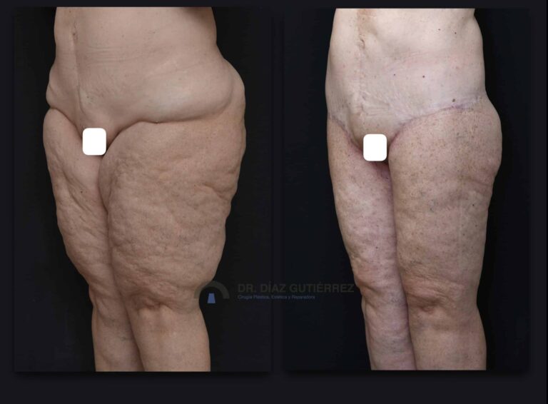 Cruroplastia: La Cirugía para Piernas Flácidas