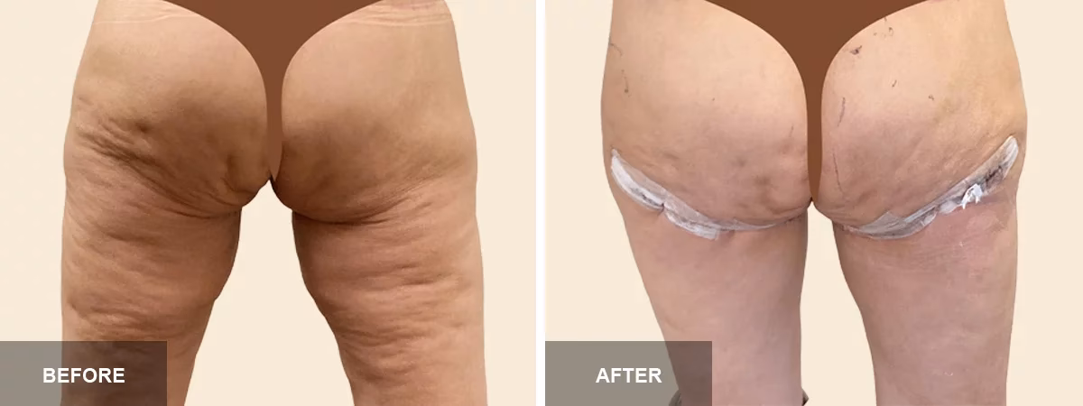 ¿Cómo se llama la cirugía estética de piernas?