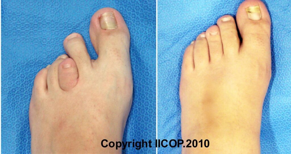 Cirugía Estética de Pies: Guía de Costos y Recuperación