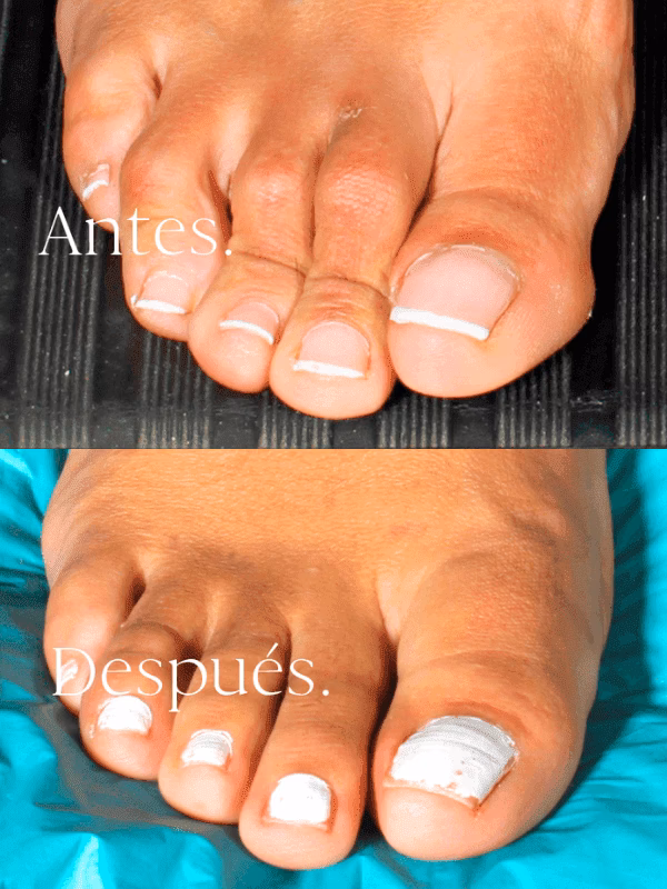 ¿Cuánto vale una operación de pies?