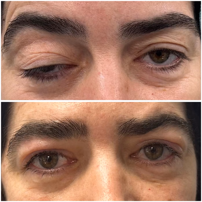 Guía completa de recuperación de la ptosis palpebral
