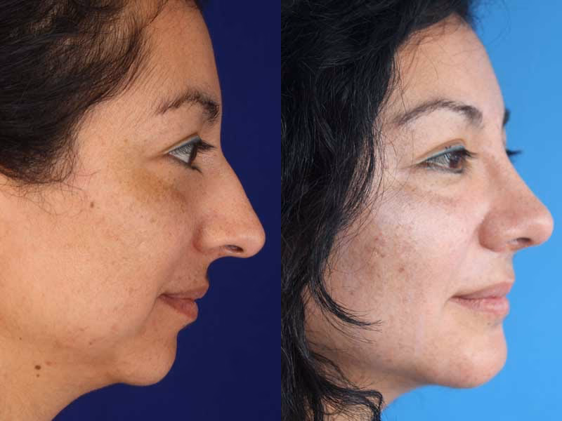 ¿Cuánto tiempo tarda en sanar una cirugía de mandíbula?