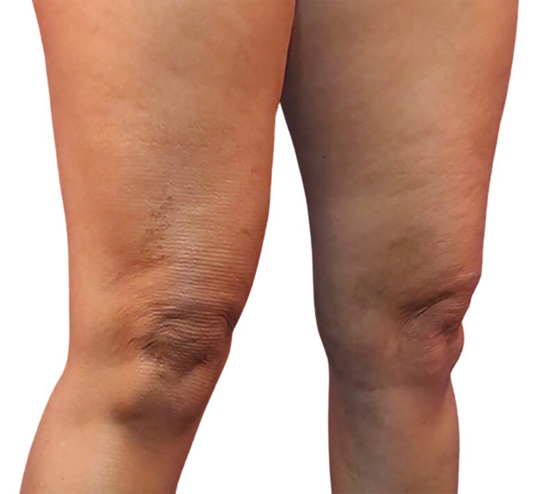 Reemplazo de Rodilla: La Guía Definitiva