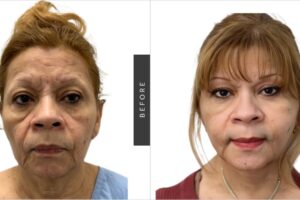Cirugía de Feminización Facial: Guía Completa