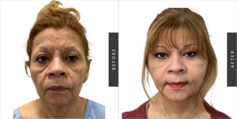Cirugía de Feminización Facial: Guía Completa