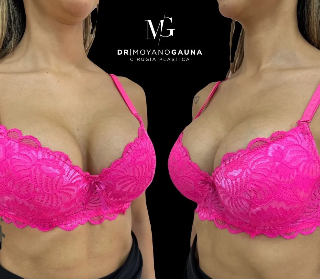 Costo de la Cirugía de Senos en Chile: Guía 2024